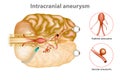 Intracranial aneurysm or brain aneurysm. Royalty Free Stock Photo