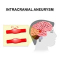 Intracranial aneurysm. cerebral or brain aneurysm. Royalty Free Stock Photo