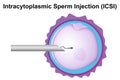 Intracytoplasmic sperm injection (ICSI) process diagram Royalty Free Stock Photo