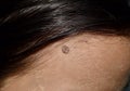 Intradermal nevus or single mole at the forehead of Southeast Asian, Myanmar young woman Royalty Free Stock Photo