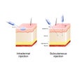 Intradermal and Subcutaneous injection