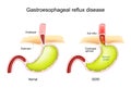 Gastroesophageal reflux disease. GERD Royalty Free Stock Photo