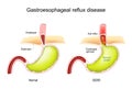 Gastroesophageal reflux disease. GERD Royalty Free Stock Photo