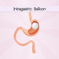 Intragastric balloon