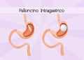 Intragastric balloon