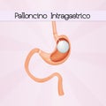 Intragastric balloon