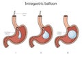 intragastric stomach balloon structure medical