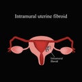 Intramural fibroids. Endometriosis. Infographics. Vector illustration on a black background