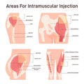 Intramuscular injection areas. Guide to injecting medication into muscle Royalty Free Stock Photo