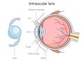 Intraocular lens structure diagram medical science Royalty Free Stock Photo