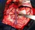 Brain surgery for a giant aneurysm