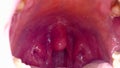 Intraoral tonsil in the mouth, tonsillitis, neglected human mouth,