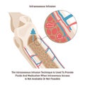 Intraosseous injection technique. Process of injecting medications