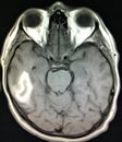Intraparenchymal hematoma brain pathology mri