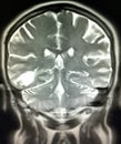 Intraparenchymal hematoma brain pathology mri
