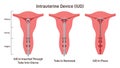 Intrauterine device. IUD placement in uterus. Female contraception