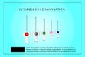 Intravenous Cannula or Branula vector icon Royalty Free Stock Photo