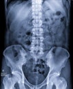 Intravenous pyelogram or I.V.P.