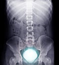 Intravenous pyelogram or I.V.P showing glowing bladder.