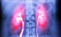 Intravenous pyelogram or I.V.P is an X-ray exam of urinary tract after injection contrast media agent