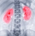 Intravenous pyelogram or I.V.P.