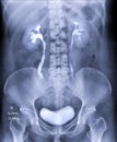 Intravenous pyelogram or I.V.P.