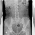 Intravenous pyelogram IVP or intravenous urogram IVU. Supine position.