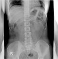 Intravenous pyelogram. Supine position. Intestinal gas partially overlying renal shadows...