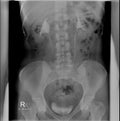 Intravenous pyelogram. There is no dilation of the pyelocaliceal system.