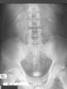 Intravenous pyelography (IVP), post-voiding film, of a 41 years old man, demonstrated enlarge both kidneys and residual urine in