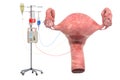 Intravenous therapy system with uterus. Treatment of uterus concept, 3D rendering