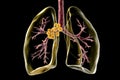 Mediastinal lymphadenitis, 3D illustration