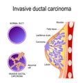 Invasive ductal carcinoma Royalty Free Stock Photo