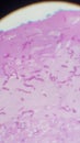 Invasive fungal hyphae on H and E tissue stain