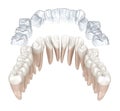 Invisalign braces or invisible retainer make bite correction. Medically accurate 3D animation