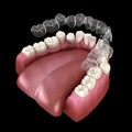 Invisalign braces or invisible retainer make bite correction. Medically accurate 3D illustration