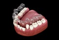 Invisalign braces or invisible retainer make bite correction. Medically accurate 3D illustration