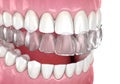 Invisalign braces or invisible retainer. Medically accurate dental 3D illustration