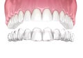 Invisalign braces or invisible retainer. Medically accurate dental 3D illustration