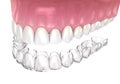 Invisalign braces or invisible retainer. Medically accurate dental 3D illustration