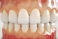 Invisible dental implant on white background - 3D Rendering