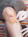 Iodine painting of bruise on knee