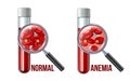 Iron deficiency anemia.The difference of Anemia amount of red blood cell and normal. Royalty Free Stock Photo