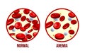 Iron deficiency anemia.The difference of Anemia amount of red blood cell and normal. Royalty Free Stock Photo