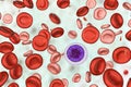 Iron deficiency anemia