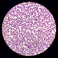 Iron deficiency Hypochromic microcytic anemia, red blood cells Royalty Free Stock Photo