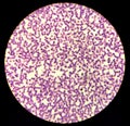 Iron deficiency Hypochromic microcytic anemia, red blood cells Royalty Free Stock Photo