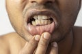 Irregular teeth male Royalty Free Stock Photo