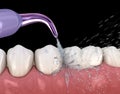 Irrigator, Water teeth cleaning. Medically accurate illustration of oral hygiene
