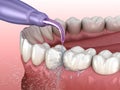 Irrigator, Water teeth cleaning. Medically accurate 3D illustration of oral hygiene